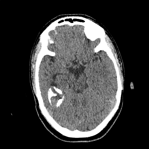 Calcified cerebral hydatid cyst (Radiopaedia 65603-74717 Axial non-contrast 23).jpg