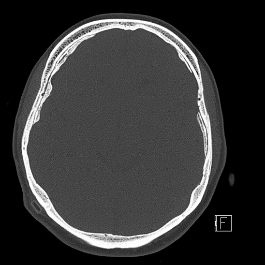 File:Calcified chronic subdural hematoma (Radiopaedia 77374-89492 Axial bone window 55).jpg