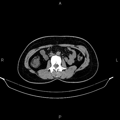 File:Calcified hepatic hydatid cyst (Radiopaedia 84672-100095 Axial non-contrast 55).jpg