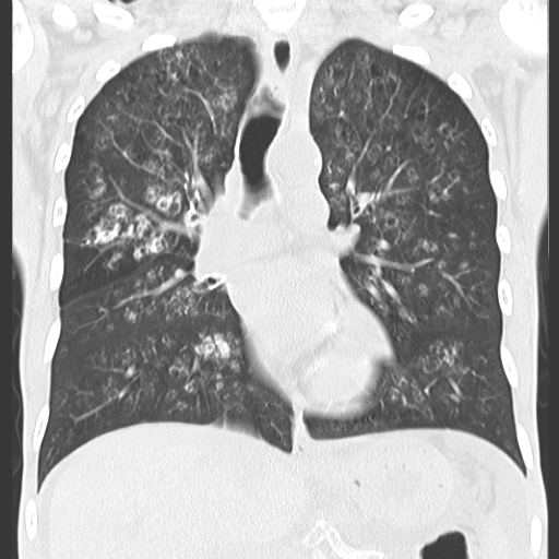 File:Calciphylaxis and metastatic pulmonary calcification (Radiopaedia 10887-11317 C 1).jpg