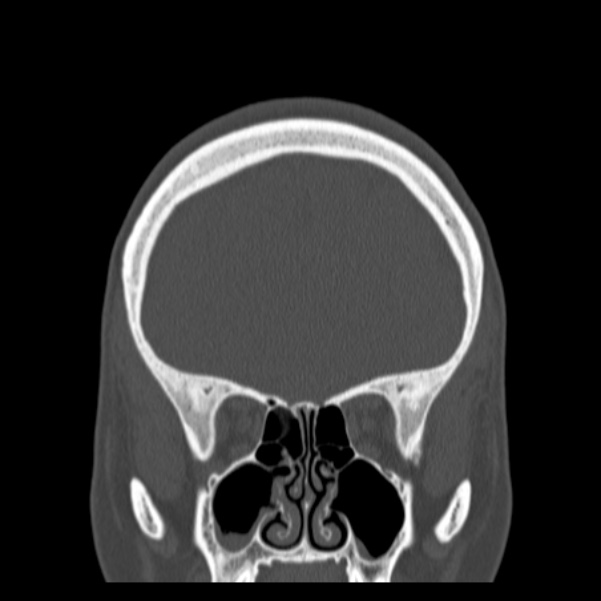 Calvarial osteoma (Radiopaedia 36520-38079 C 26).jpg