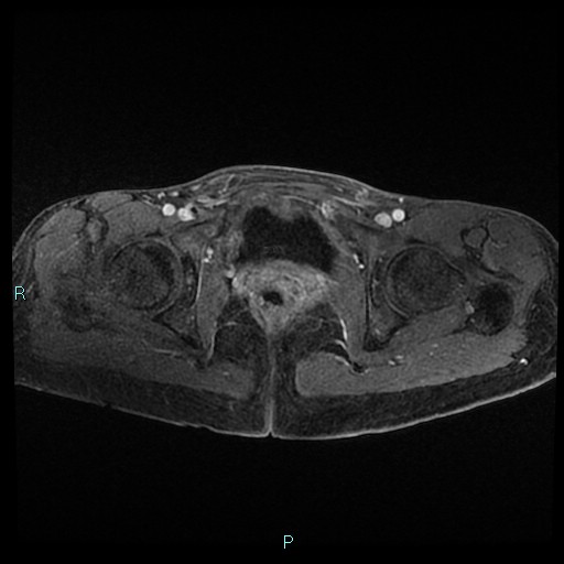 File:Canal of Nuck cyst (Radiopaedia 55074-61448 Axial T1 C+ fat sat 42).jpg