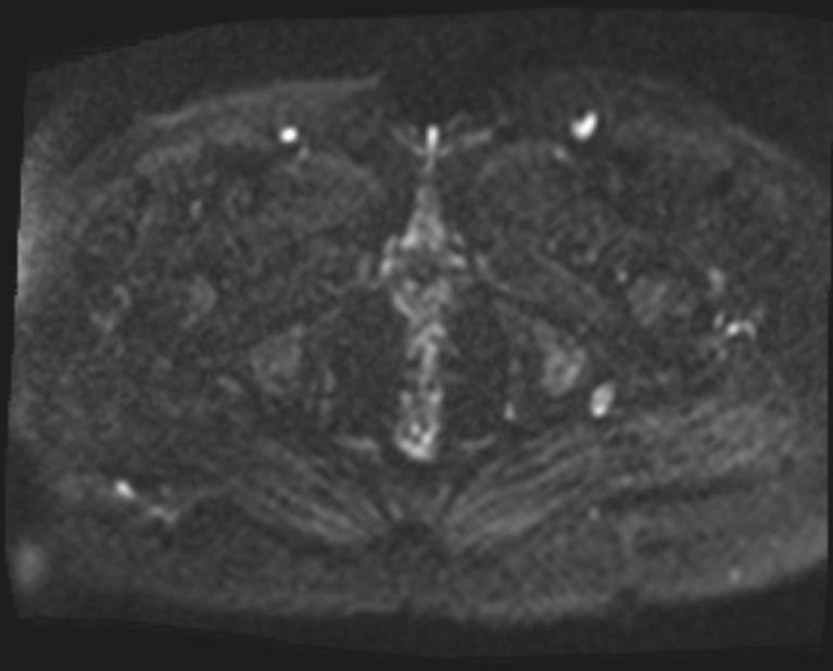 Cancer cervix - stage IIb (Radiopaedia 75411-86615 Axial DWI 31).jpg