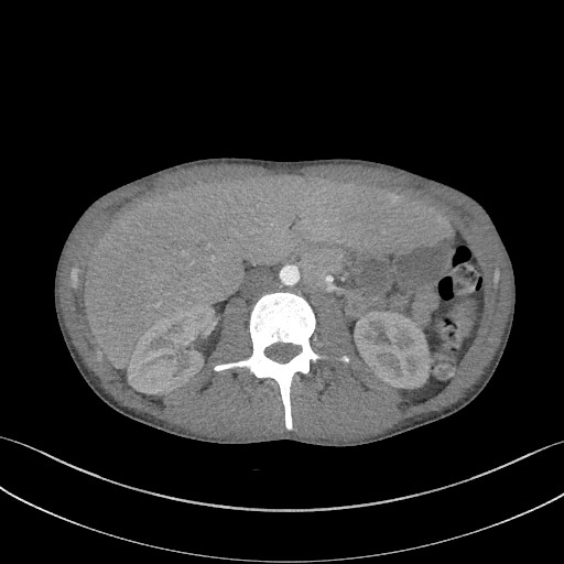 File:Cannonball metastases - testicular choriocarcinoma (Radiopaedia 84510-99891 B 124).jpg