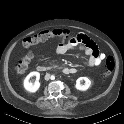 Cannonball metastases from endometrial cancer (Radiopaedia 42003-45031 E 37).png
