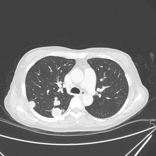 File:Canonball lung metastasis (Radiopaedia 77634-89837 Axial lung window 67).jpg