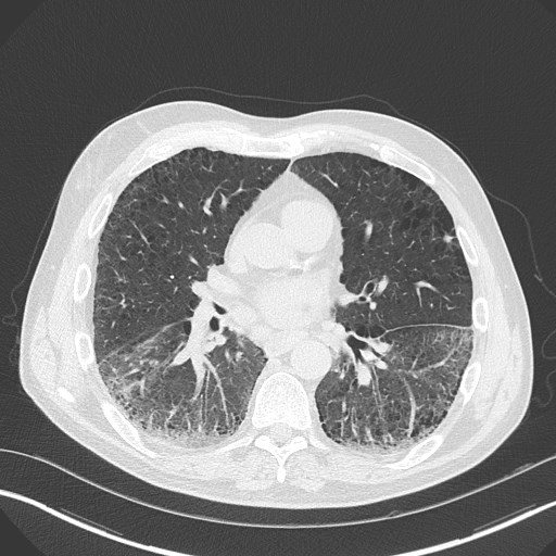 Caplan syndrome (Radiopaedia 56667-63530 Axial lung window 111).jpg