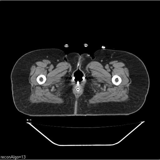 Carcinoma cervix- brachytherapy applicator (Radiopaedia 33135-34173 Axial non-contrast 55).jpg