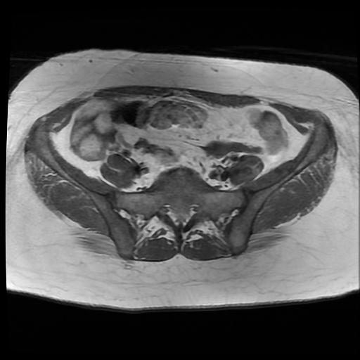 File:Carcinoma of the cervix (Radiopaedia 89018-105858 Axial T1 1).jpg