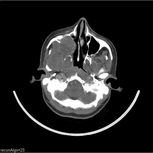 Carcinoma of the maxillary antrum (Radiopaedia 53805-59888 Axial C+ delayed 55).jpg