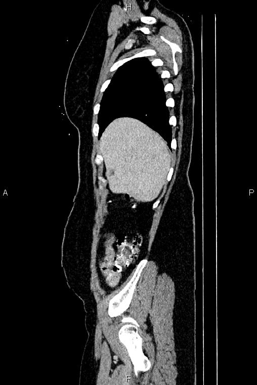 Carcinoma of uterine cervix (Radiopaedia 85861-101700 D 8).jpg
