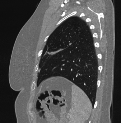 Cardiac sarcoidosis (Radiopaedia 74548-85534 Sagittal lung window 15).jpg