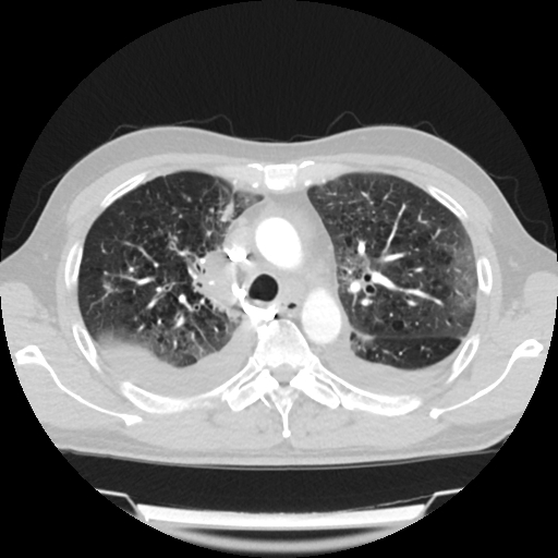 Cardiac tamponade (Radiopaedia 78607-91368 Axial lung window 24).jpg