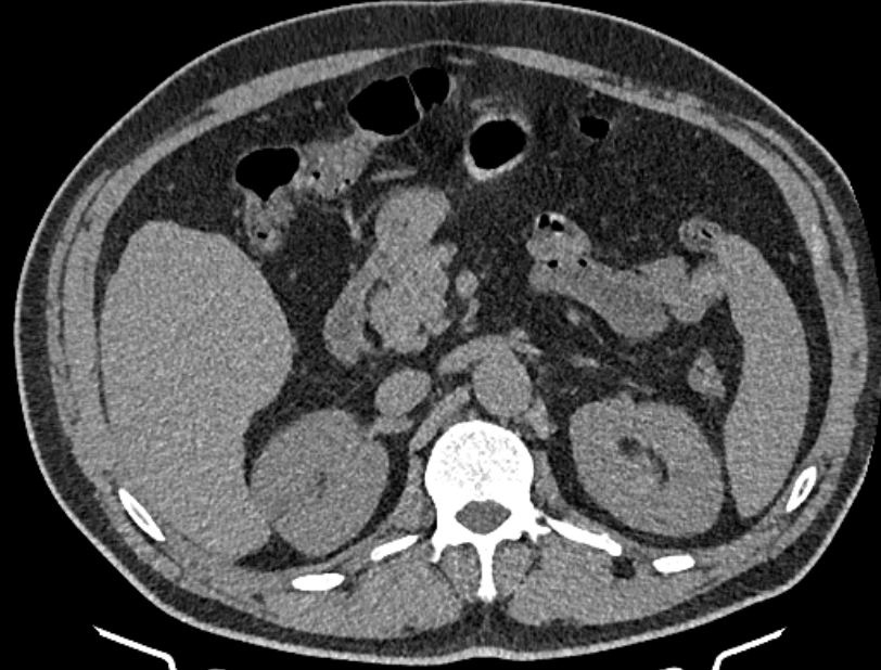 Cardiogenic pulmonary edema (Radiopaedia 68180-77678 Axial non-contrast 71).jpg