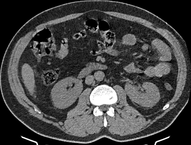 Cardiogenic pulmonary edema (Radiopaedia 68180-77678 Axial non-contrast 84).jpg
