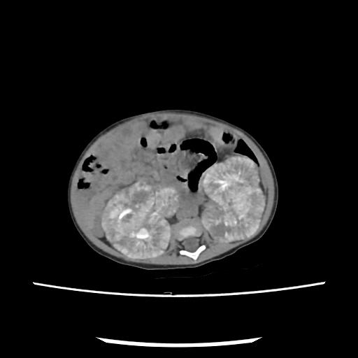 Caroli disease with autosomal recessive polycystic kidney disease (ARPKD) (Radiopaedia 89651-106703 E 119).jpg
