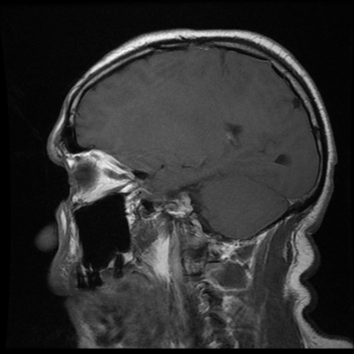 File:Carotid arterial dissection with acute cerebral infarction (Radiopaedia 26636-26784 Sagittal T1 C+ 13).jpg