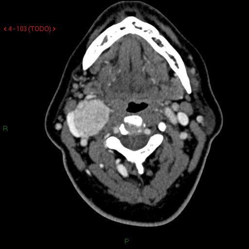 File:Carotid body tumor (Radiopaedia 20564-20462 C 1).jpg
