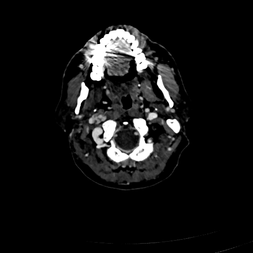 Carotid body tumor (Radiopaedia 83615-98727 D 35).jpg