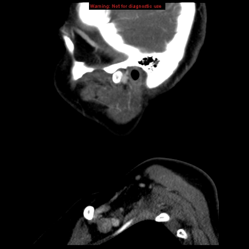 Carotid body tumor with lung metastases (Radiopaedia 9301-9986 Sagittal C+ delayed 3).jpg