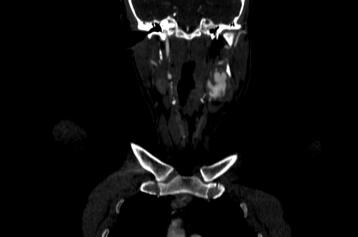 File:Carotid bulb pseudoaneurysm (Radiopaedia 57670-64616 D 9).jpg