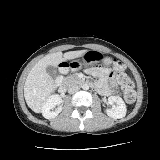 Castleman disease with fibrous pseudotumor in the abdomen (Radiopaedia 77296-89373 A 49).jpg