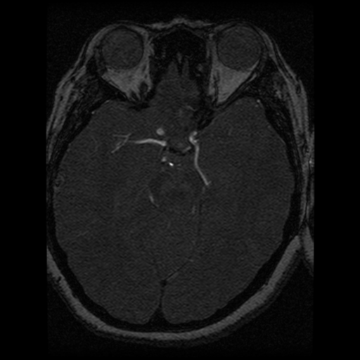 Cavernoma, DVA and right ICA aneurysm (Radiopaedia 33890-35072 E 49).png