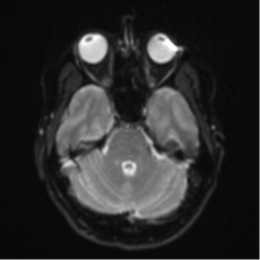 File:Cavernoma with bleed - midbrain (Radiopaedia 54546-60774 Axial DWI 7).png