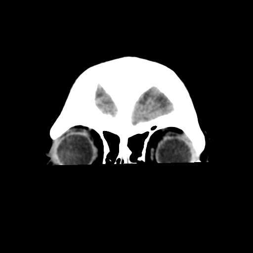 Cavernoma with hemorrhage (Radiopaedia 70755-80931 Coronal non-contrast 9).png