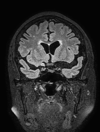 Cavernous hemangioma of the cerebellar falx (Radiopaedia 73025-83724 Coronal FLAIR 123).jpg