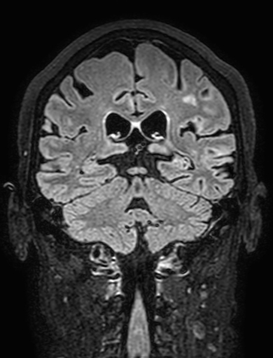 Cavernous hemangioma of the cerebellar falx (Radiopaedia 73025-83724 Coronal FLAIR 222).jpg