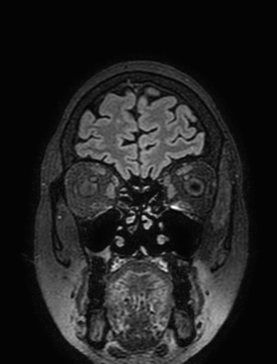 Cavernous hemangioma of the cerebellar falx (Radiopaedia 73025-83724 Coronal FLAIR 49).jpg