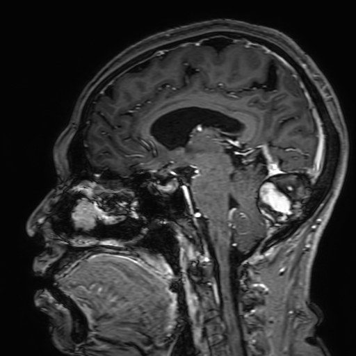 Cavernous hemangioma of the cerebellar falx (Radiopaedia 73025-83724 Sagittal T1 C+ 99).jpg