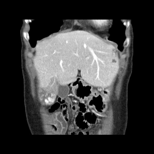 Cavernous hepatic hemangioma (Radiopaedia 75441-86667 C 32).jpg