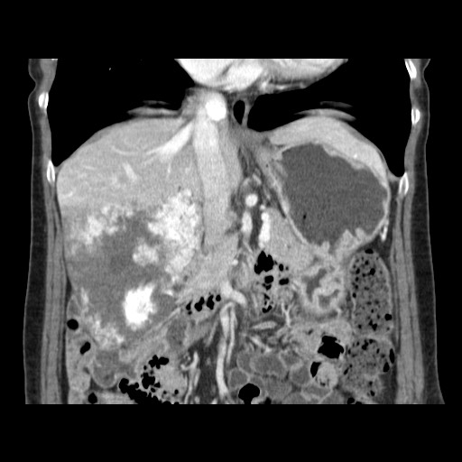 Cavernous hepatic hemangioma (Radiopaedia 75441-86667 C 65).jpg