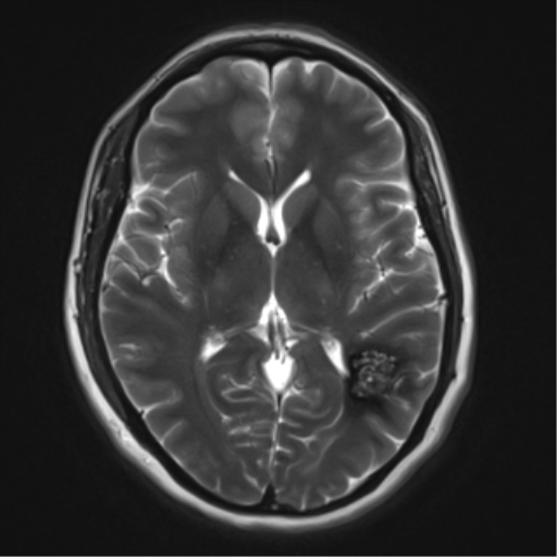 File:Cavernous malformation (cavernous angioma or cavernoma) (Radiopaedia 36675-38237 Axial T2 11).png