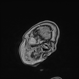 File:Cavernous sinus meningioma (Radiopaedia 63682-72367 Sagittal T1 C+ 21).jpg
