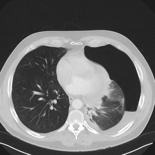 File:Cavitating pneumonia complicated by pneumothorax (Radiopaedia 48149-52994 Axial lung window 43).png