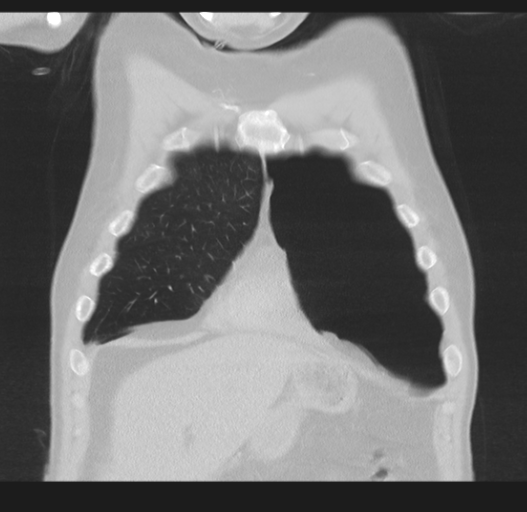Cavitating pneumonia complicated by pneumothorax (Radiopaedia 48149-52994 Coronal lung window 13).png