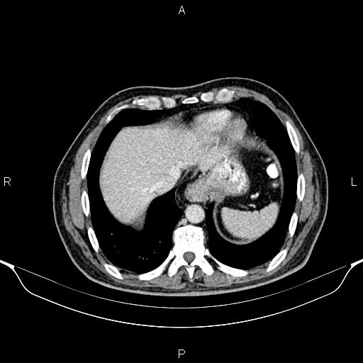 Cecal adenocarcinoma (Radiopaedia 85324-100916 B 10).jpg