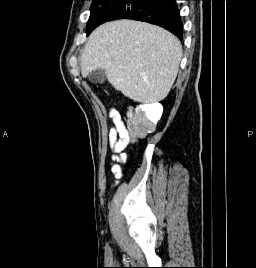 Cecal adenocarcinoma (Radiopaedia 85324-100916 E 15).jpg