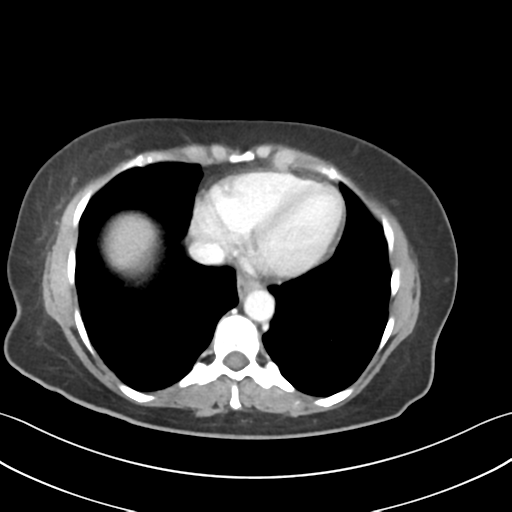 Cecum hernia through the foramen of Winslow (Radiopaedia 46634-51112 A 6).png
