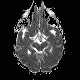 File:Central-variant posterior reversible encephalopathy syndrome (PRES) (Radiopaedia 43880-47358 Axial ADC 9).jpg