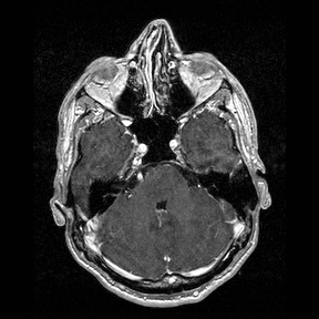 Central-variant posterior reversible encephalopathy syndrome (PRES) (Radiopaedia 43880-47358 Axial T1 C+ 37).jpg