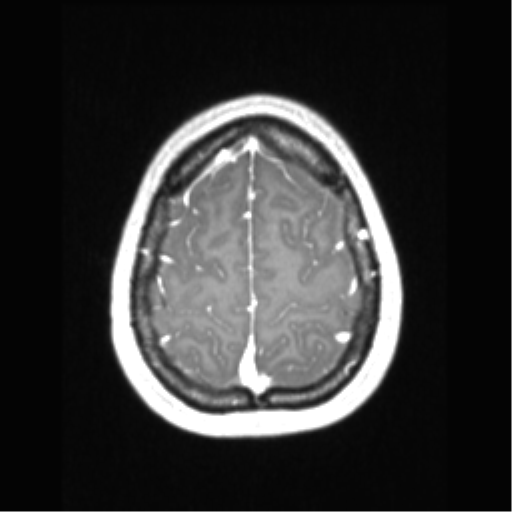 File:Central neurocytoma (Radiopaedia 37664-39557 Axial T1 C+ 68).png