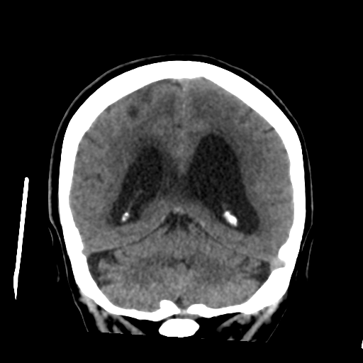 File:Central neurocytoma (Radiopaedia 65317-74346 Coronal non-contrast 41).png
