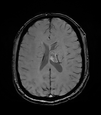 File:Central neurocytoma (Radiopaedia 71068-81303 Axial SWI 40).jpg