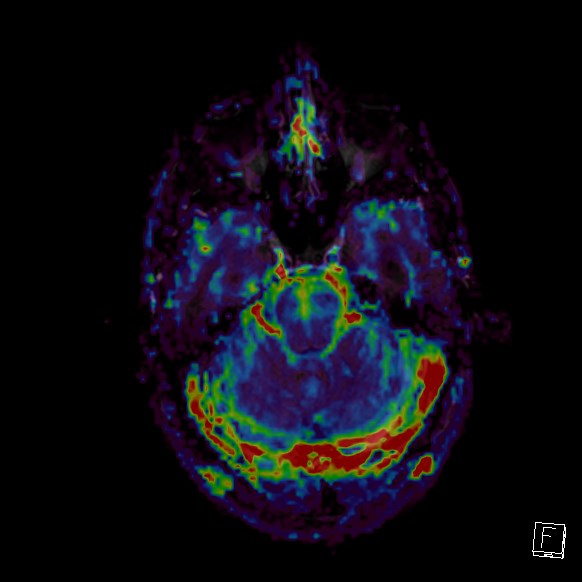 Central neurocytoma (Radiopaedia 84497-99872 Axial Perfusion 236).jpg
