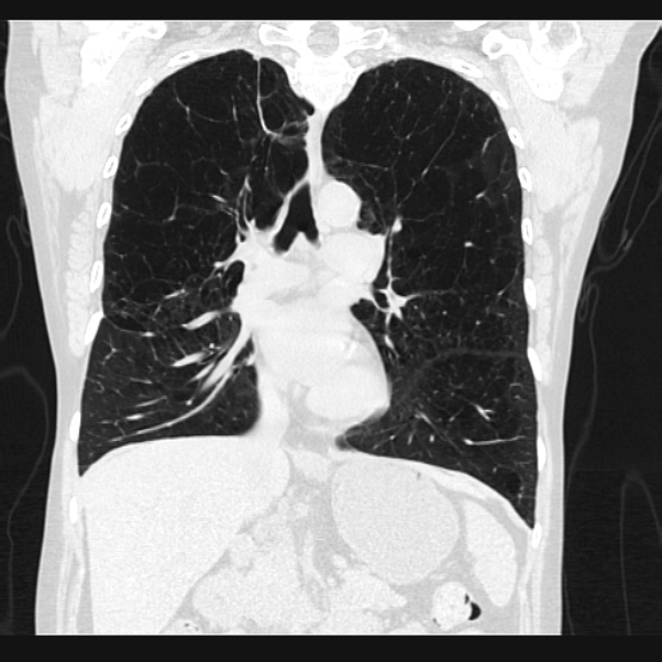 Centrilobular pulmonary emphysema (Radiopaedia 24495-24789 Coronal lung window 37).jpg