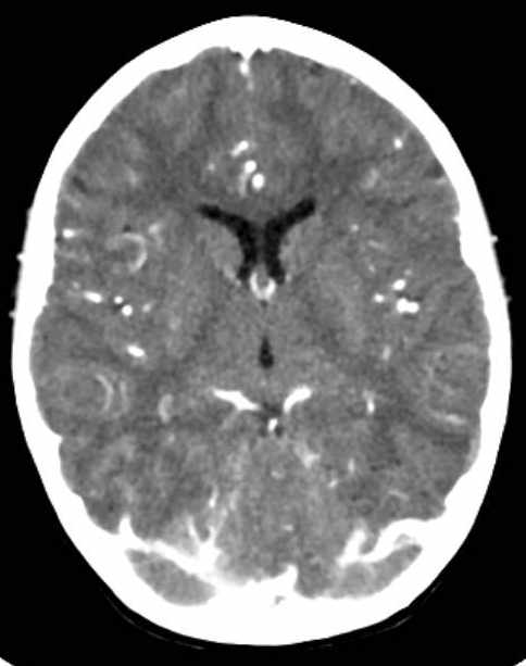 Cerebellar abscess (Radiopaedia 73727-84527 Axial C+ 41).jpg